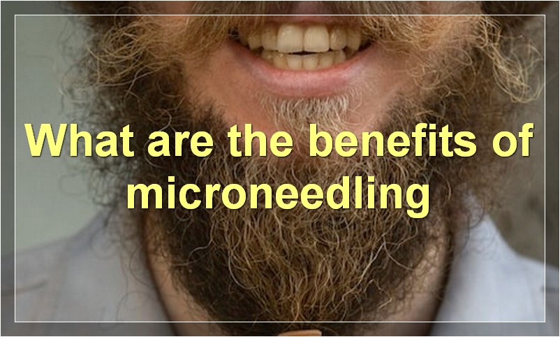 What are the benefits of microneedling